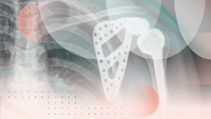 X-ray image of a shoulder with an implant.